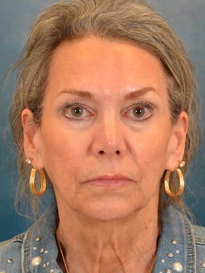 Laser Skin Resurfacing Before & After Gallery - Patient 313941 - Image 1