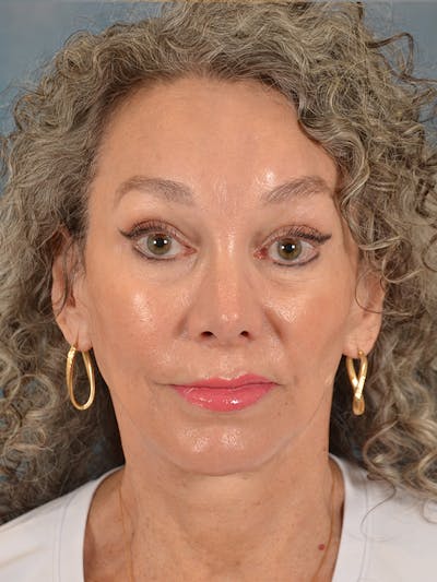 Laser Skin Resurfacing Before & After Gallery - Patient 313941 - Image 2