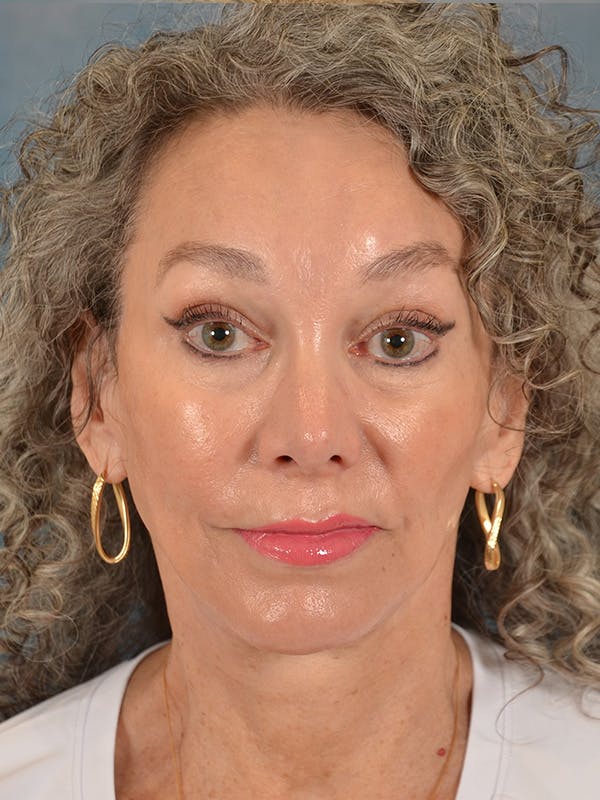 Laser Skin Resurfacing Before & After Gallery - Patient 313941 - Image 2