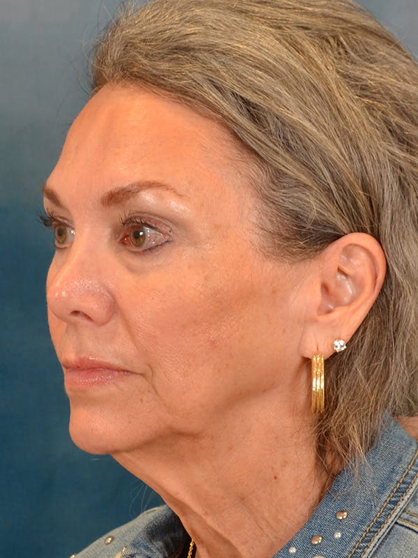 Laser Skin Resurfacing Before & After Gallery - Patient 313941 - Image 3