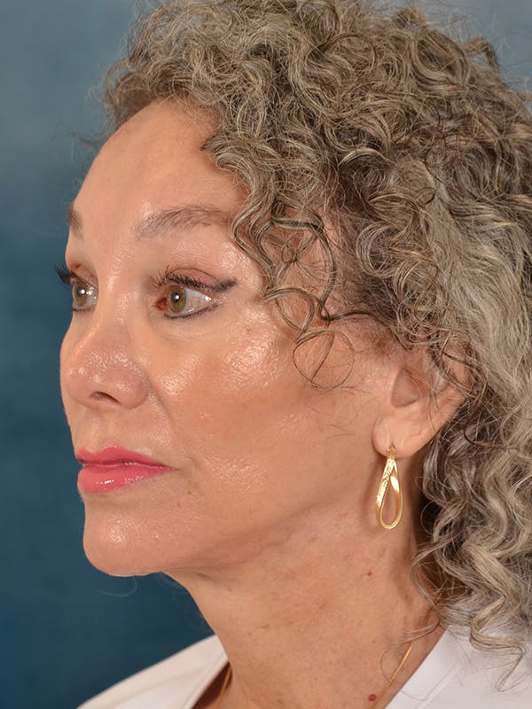 Laser Skin Resurfacing Before & After Gallery - Patient 313941 - Image 4