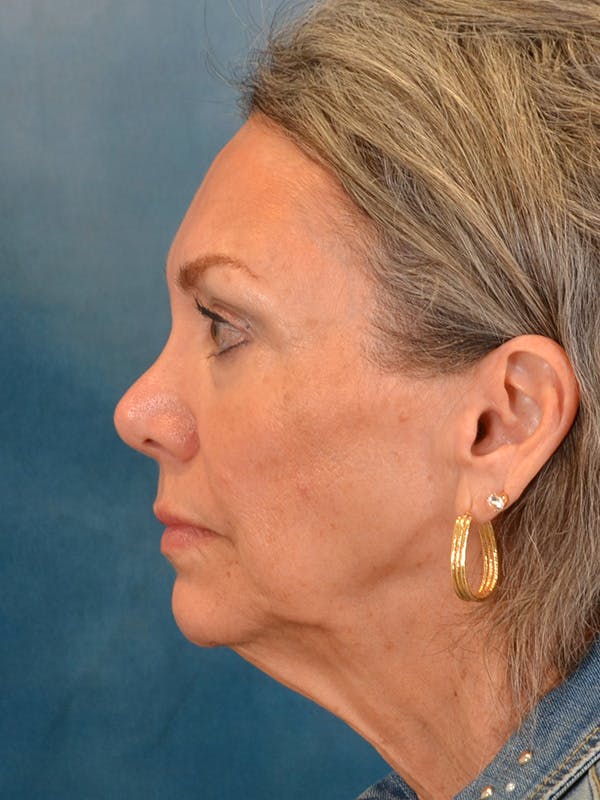 Laser Skin Resurfacing Before & After Gallery - Patient 313941 - Image 5