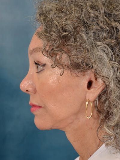 Laser Skin Resurfacing Before & After Gallery - Patient 313941 - Image 6