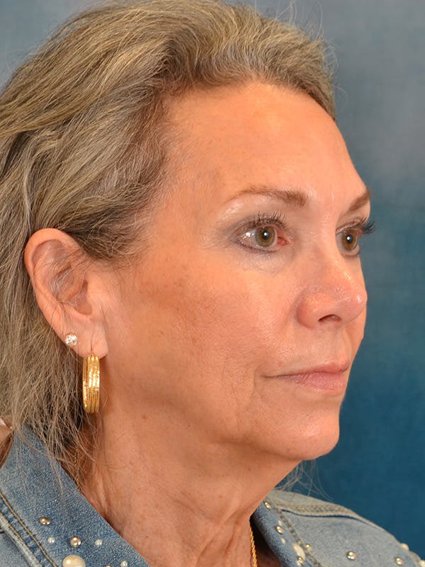 Laser Skin Resurfacing Before & After Gallery - Patient 313941 - Image 7