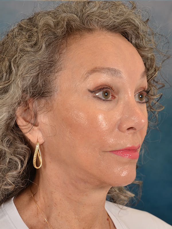 Laser Skin Resurfacing Before & After Gallery - Patient 313941 - Image 8