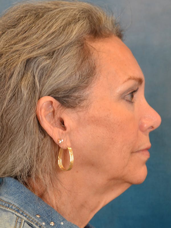 Laser Skin Resurfacing Before & After Gallery - Patient 313941 - Image 9