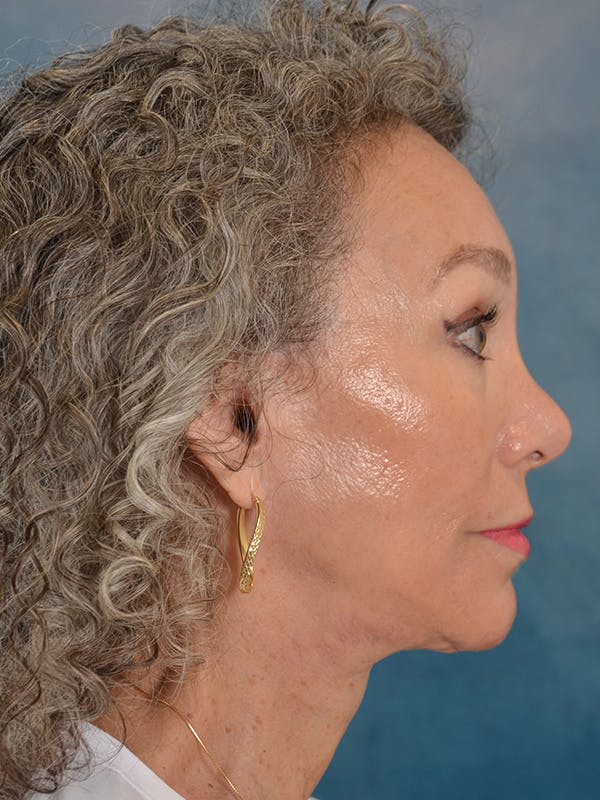 Laser Skin Resurfacing Before & After Gallery - Patient 313941 - Image 10