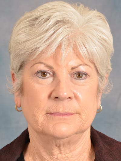 Laser Skin Resurfacing Before & After Gallery - Patient 392854 - Image 1