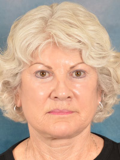 Laser Skin Resurfacing Before & After Gallery - Patient 392854 - Image 2