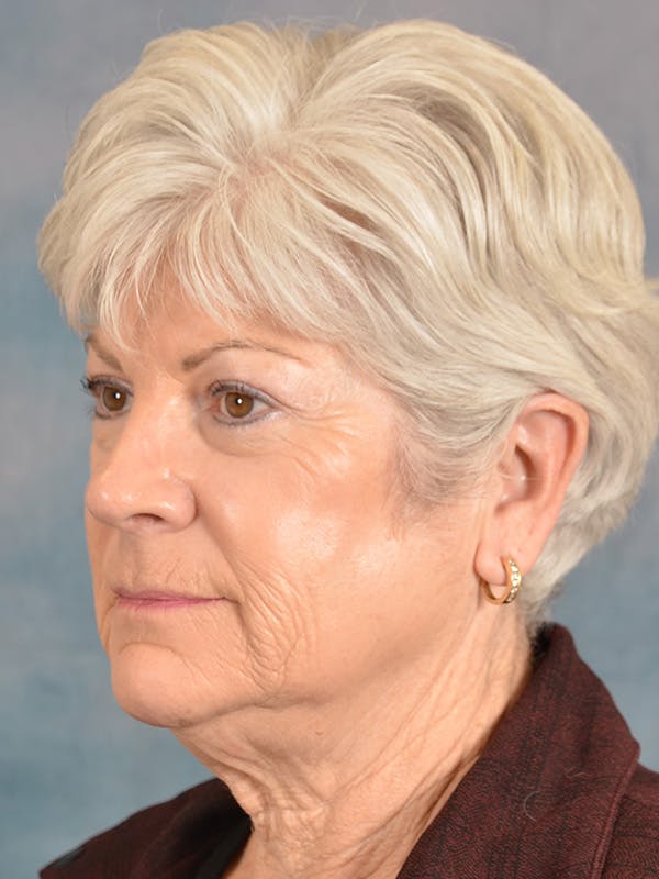 Laser Skin Resurfacing Before & After Gallery - Patient 392854 - Image 3