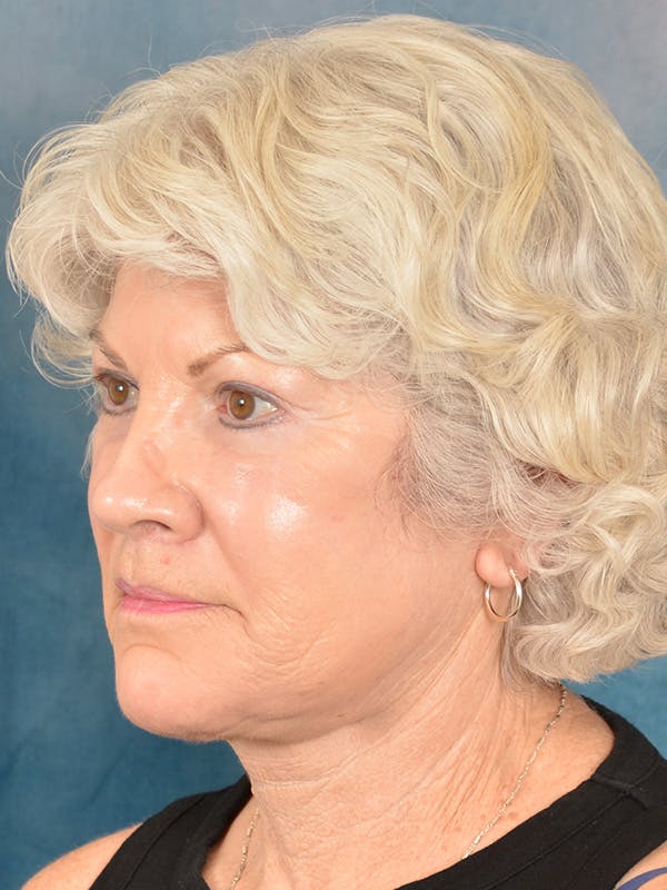 Laser Skin Resurfacing Before & After Gallery - Patient 392854 - Image 4