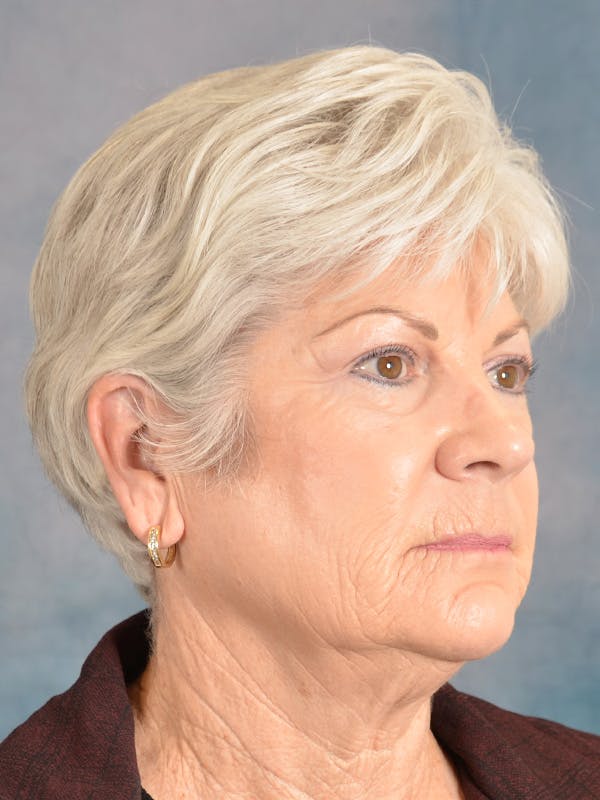 Laser Skin Resurfacing Before & After Gallery - Patient 392854 - Image 5