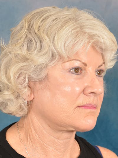 Laser Skin Resurfacing Before & After Gallery - Patient 392854 - Image 6