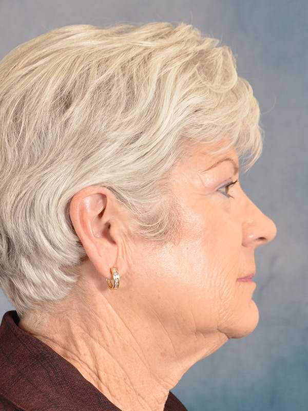 Laser Skin Resurfacing Before & After Gallery - Patient 392854 - Image 7
