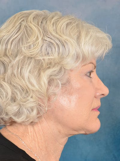 Laser Skin Resurfacing Before & After Gallery - Patient 392854 - Image 8