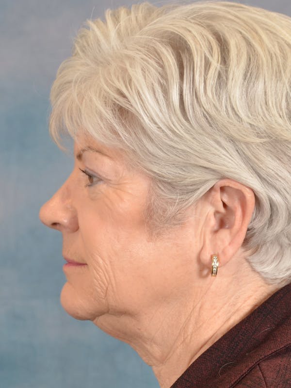 Laser Skin Resurfacing Before & After Gallery - Patient 392854 - Image 9
