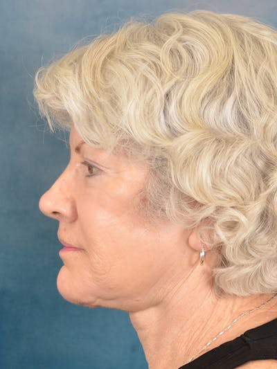 Laser Skin Resurfacing Before & After Gallery - Patient 392854 - Image 10