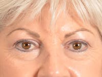 Eyelid Lift Before & After Gallery - Patient 196562 - Image 1