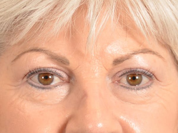 Eyelid Lift Before & After Gallery - Patient 196562 - Image 1