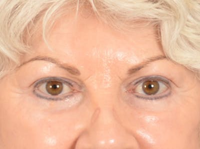 Eyelid Lift Before & After Gallery - Patient 196562 - Image 2