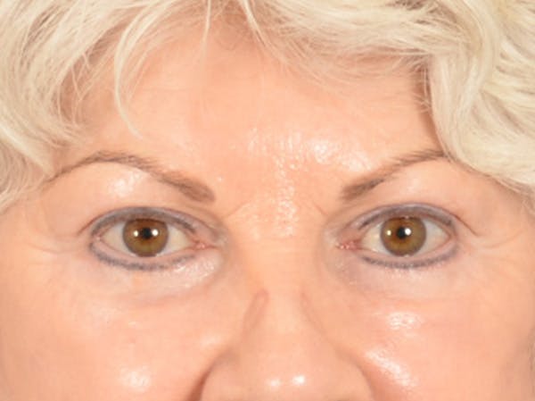 Eyelid Lift Before & After Gallery - Patient 196562 - Image 2