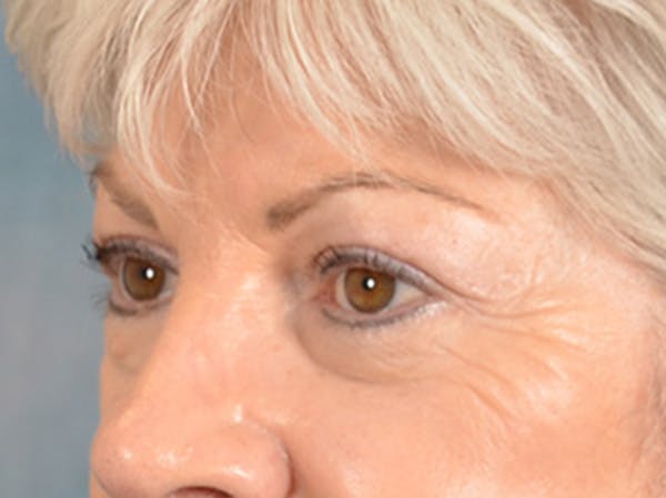 Eyelid Lift Before & After Gallery - Patient 196562 - Image 3