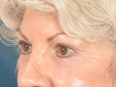 Eyelid Lift Before & After Gallery - Patient 196562 - Image 4