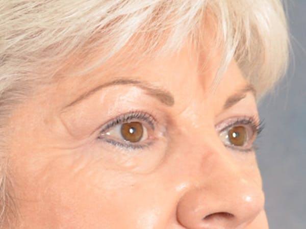 Eyelid Lift Before & After Gallery - Patient 196562 - Image 5