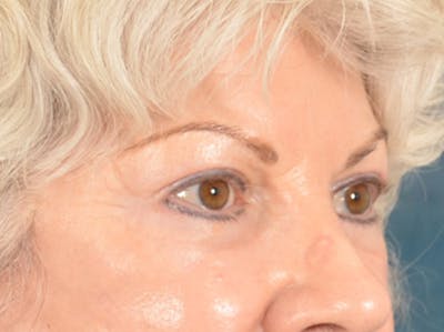 Eyelid Lift Before & After Gallery - Patient 196562 - Image 6