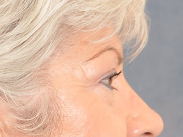 Eyelid Lift Before & After Gallery - Patient 196562 - Image 7