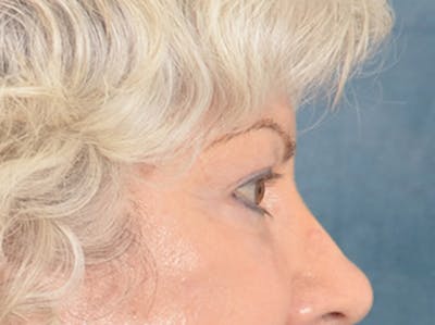 Eyelid Lift Before & After Gallery - Patient 196562 - Image 8