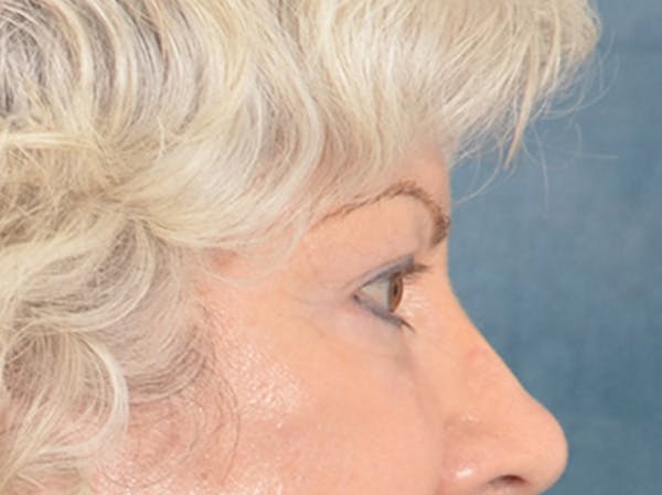 Eyelid Lift Before & After Gallery - Patient 196562 - Image 8