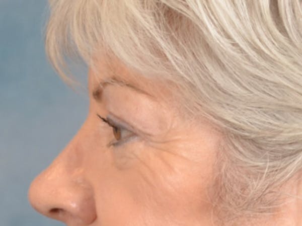 Eyelid Lift Before & After Gallery - Patient 196562 - Image 9