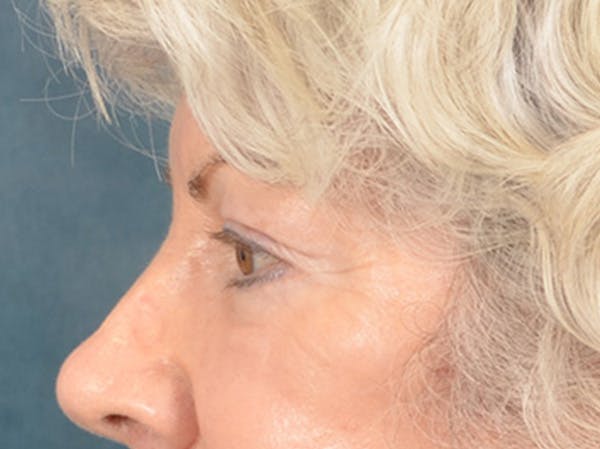 Eyelid Lift Before & After Gallery - Patient 196562 - Image 10