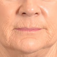 Lip Lift Before & After Gallery - Patient 850025 - Image 1