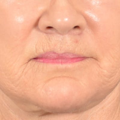 Lip Lift Before & After Gallery - Patient 850025 - Image 2