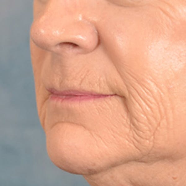 Lip Lift Before & After Gallery - Patient 850025 - Image 3