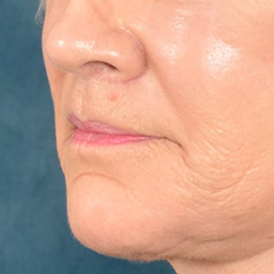 Lip Lift Before & After Gallery - Patient 850025 - Image 4