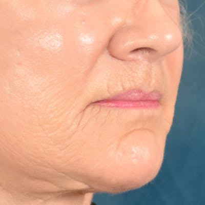 Lip Lift Before & After Gallery - Patient 850025 - Image 6
