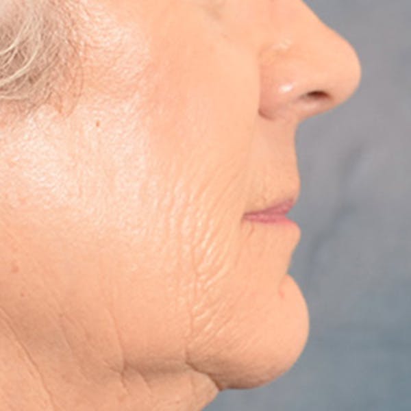 Lip Lift Before & After Gallery - Patient 850025 - Image 7
