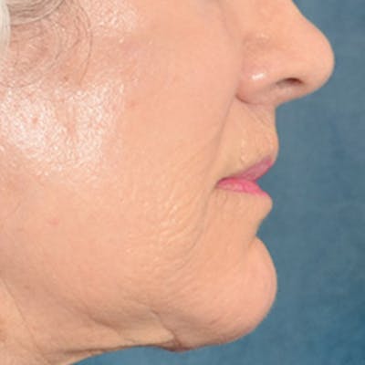 Lip Lift Before & After Gallery - Patient 850025 - Image 8