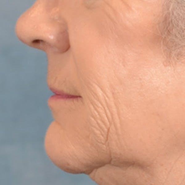 Lip Lift Before & After Gallery - Patient 850025 - Image 9