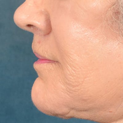 Lip Lift Before & After Gallery - Patient 850025 - Image 10