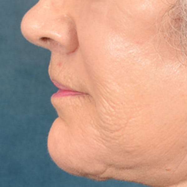 Lip Lift Before & After Gallery - Patient 850025 - Image 10