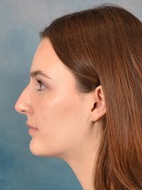 Rhinoplasty Before & After Gallery - Patient 302588 - Image 1
