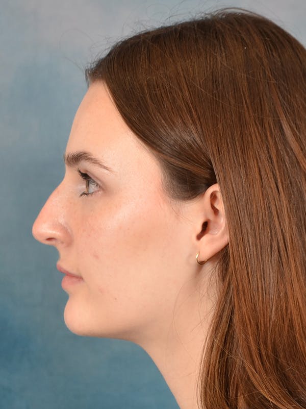 Rhinoplasty Before & After Gallery - Patient 302588 - Image 1