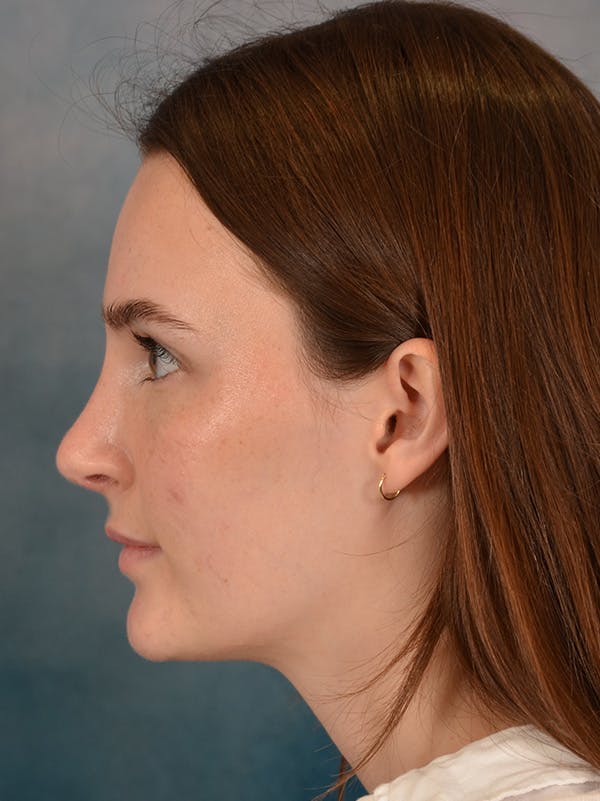 Rhinoplasty Before & After Gallery - Patient 302588 - Image 2