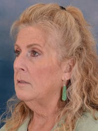 Deep Plane Facelift Before & After Gallery - Patient 256091 - Image 1