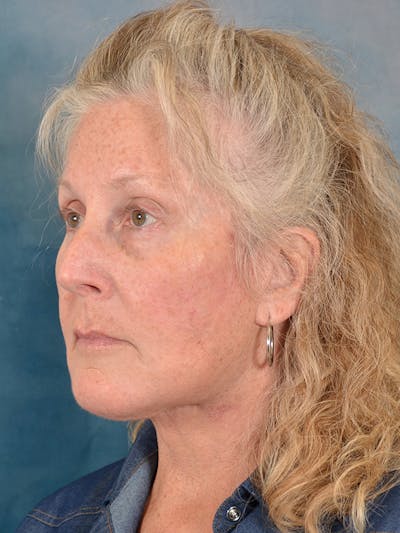 Brow Lift Before & After Gallery - Patient 256405 - Image 4