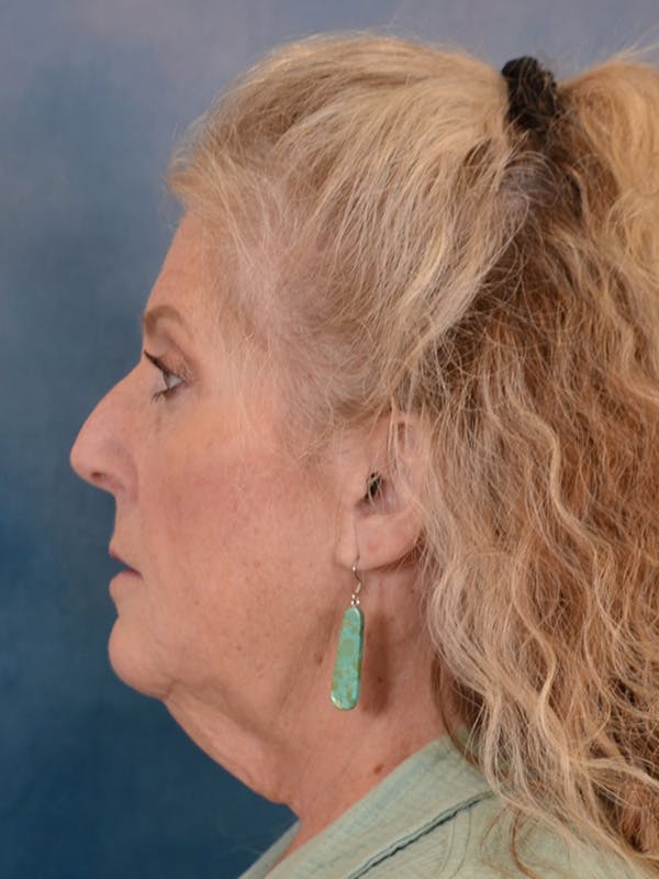 Brow Lift Before & After Gallery - Patient 256405 - Image 5